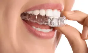 Dita che posizionano un apparecchio di contenzione trasparente sui denti bianchi.