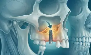 Impianto dentale inserito nell'osso mascellare, vicino all'antro di Higmoro.