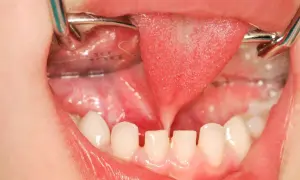 Bocca di bambino con lingua retratta da frenulo linguale corto, denti da latte e strumenti dentistici.