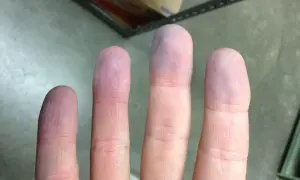 Dita con colorazione bluastra, possibili cause da indagare.