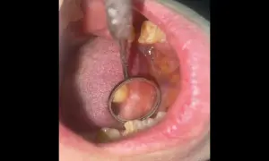 Area bianca sulla guancia interna, possibile leucoplachia. Esame dentistico in corso.