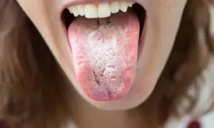 Lingua con placche biancastre e rossore, possibile candidosi orale.