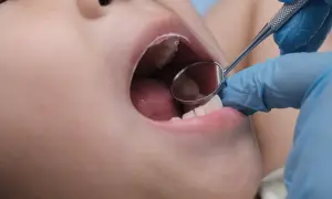 Esame dentistico: un piccolo specchietto riflette la bocca aperta di un bambino, mostrando la lingua e alcuni puntini sul palato.