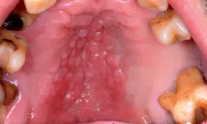 Ingrandimento del palato con un evidente **rilievo sul palato**, caratterizzato da papule e arrossamento.