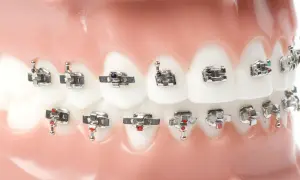 Modello di denti con apparecchio ortodontico, con attacchi metallici e fili che sembrano piccole stelline.