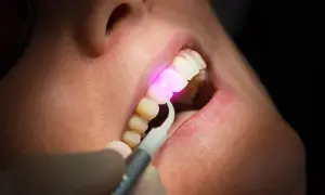 Trattamento dentale con laser. Un raggio rosa illumina un dente, mostrando la precisione della laser dentistry.