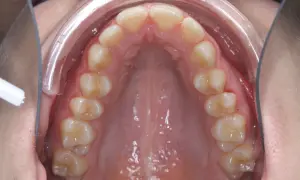 Vista interna della bocca con denti superiori e palato. Si nota un leggero mento retratto, con un divaricatore che espone l'arcata dentale.