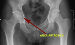 Radiografia del bacino che mostra una rima di radiotrasparenza nell'anca destra, indicata da una freccia rossa e dalla scritta "ANCA ARTROSICA".
