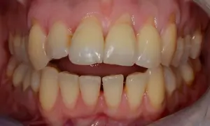 Vista ravvicinata di un morso incrociato laterale in adulti, con denti superiori che coprono quelli inferiori.