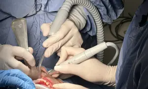 Denti puliti e sani grazie a una pulizia denti con anestesia. Strumenti dentali in azione.