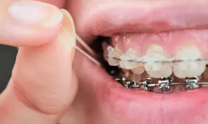 Dita che posizionano elastici sull'apparecchio dentale. A volte gli elastici apparecchio fanno male, ma sono necessari per allineare i denti.