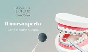 Modello di denti con apparecchio ortodontico mostra un morso aperto. Un dentista esamina il caso.