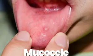 Piccolo mucocele, una cisti da ritenzione, appare sulla mucosa interna della bocca, evidenziata da dita.