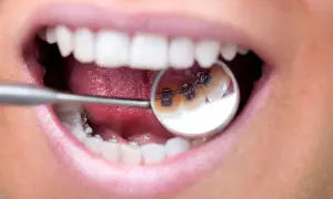 Primo piano di una bocca con apparecchio dentale. Il morso profondo apparecchio è visibile nello specchietto del dentista.