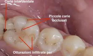 Dente con carie interdentale e piccole carie occlusali. Si nota un puntino nero sul dente, segno di un problema da affrontare.