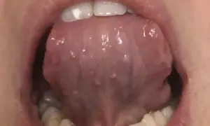 Lingua con piccole protuberanze, forse un papilloma sotto la lingua, visibile con i denti in primo piano.