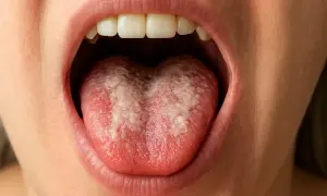 Bocca adulta con lingua arrossata e macchie bianche, suggestive di mughetto.