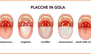 Illustrazione di cinque bocche aperte che mostrano diverse condizioni della gola, tra cui placche e calcoli tonsillari.