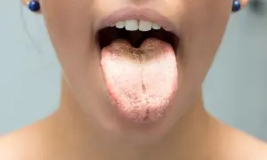 Lingua con patina biancastra e rossastra, possibile sintomo di candida labbra.