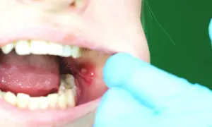 Dito un afte bucale, con una piccola lesione infiammata sulla guancia interna, evidenziata da un dito guantato.