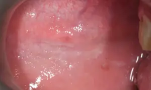 Mucosa orale con aree biancastre e arrossate, indicative di morsicatio buccarum, un'abitudine di mordicchiarsi le guance.
