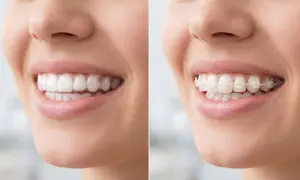 Primo piano di un sorriso con apparecchio trasparente e poi con apparecchio fisso.