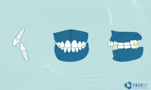 Illustrazione di denti sporgenti, prima e dopo il trattamento ortodontico.