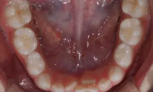 Vista ravvicinata della bocca di un adulto con denti sani, alcuni con piccole bollicine. Si nota una leggera sovrapposizione di alcuni denti, suggerendo una possibile necessità di correzione ortodontica per i denti doppia fila adulti.
