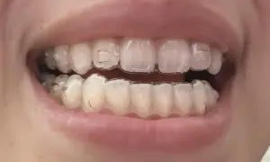 Denti con Invisalign, pronti per mangiare uno yogurt cremoso.