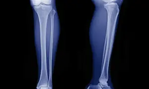 Radiografie delle gambe mostrano un fibroma ossificante, una lesione benigna che coinvolge la tibia e il perone.