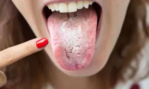 Lingua con placche biancastre, sintomo di leucopatia in bocca. Un dito con smalto rosso indica la zona interessata.