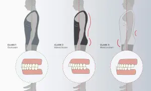Classi di occlusione dentale: 1 (normale), 2 (malocclusione) e 3 (malocclusione), con profili posturali associati.