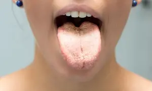 Lingua con patina biancastra, suggerisce sciacqui con bicarbonato per lingua per una pulizia profonda.