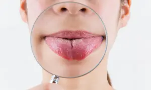Primo piano di una bocca con una lente d'ingrandimento che mostra una lingua con una profonda fessura centrale, una lingua spaccata.
