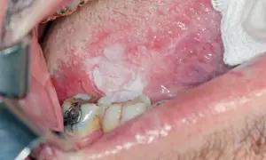 Lesione bianca sulla lingua, in attesa di biopsia escissionale.