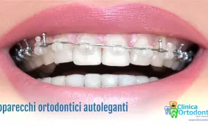 Primo piano di un sorriso con apparecchio autolegante trasparente e metallico.