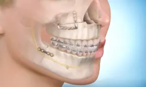 Modello 3D di un volto con apparecchio ortodontico e placche metalliche per la correzione della mascella, evidenziando una potenziale antrostomia mascellare.