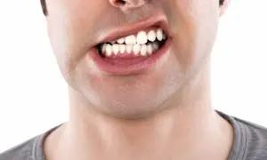 Primo piano di un uomo con denti visibili, che mostra una possibile malocclusione dentale adulti.