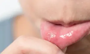 Dito un dito che tocca una piccola afte sulla lingua, irritata e dolorante.