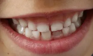 Denti con opacità e striature biancastre, segni di ipomineralizzazione denti, che rendono lo smalto più fragile.
