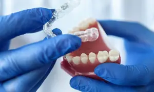 Mani guantate mostrano un bite notturno trasparente su un modello di denti.