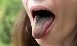 Lingua con patina scura e un piccolo puntino nero visibile.