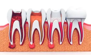 Illustrazione di un dente devitalizzato: dalla polpa infiammata alla sigillatura dei canali radicolari.