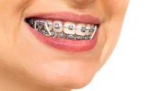 Sorriso con apparecchio ortodontico e elastici intermascellari, per un allineamento perfetto dei denti.