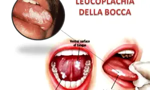 Leucoplachia della bocca: lesioni biancastre su lingua e pavimento orale. Non è una malattia che porta alla morte, ma un segnale da non sottovalutare.