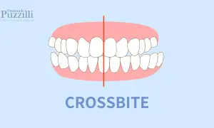 Illustrazione di un morso testa a testa, dove i denti superiori coprono quelli inferiori. Il termine "CROSSBITE" è scritto in basso.