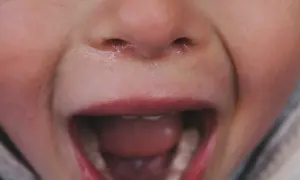 Bocca aperta di un bambino con denti storti da ciuccio, naso umido e labbra rosse.