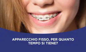 Sorriso di una ragazza con apparecchio fisso. Scopri quanto tempo ci vuole per mettere l'apparecchio e per quanto tempo si tiene.