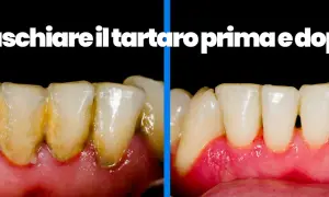Denti con tartaro prima e dopo la pulizia. Scopri come pulire i denti dal tartaro a casa per un sorriso smagliante.