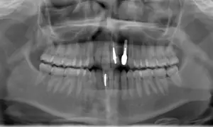 Radiografia panoramica dentale che mostra la sinfisi mandibolare con impianti dentali nella mascella e nella mandibola.